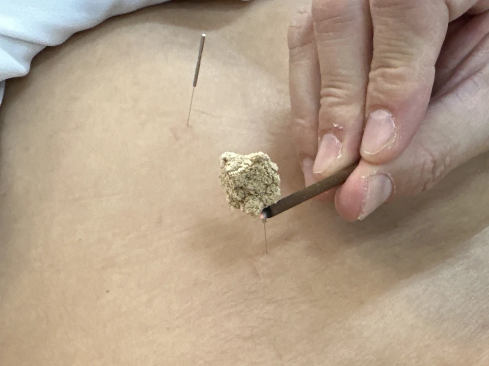 アキレス腱炎、足底筋膜炎、シンスプリントの施術の写真